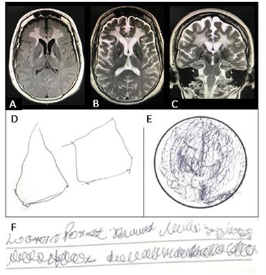 Uterus infantilis: a novel phenotype associated with AARS2 new genetic variants. A case report